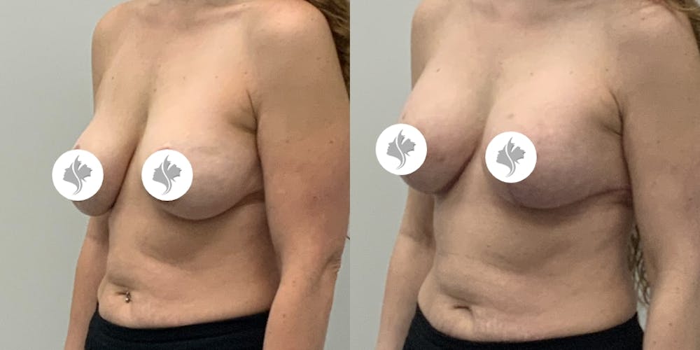 This is one of our beautiful breast asymmetry correction patient #20