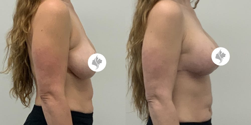 This is one of our beautiful breast asymmetry correction patient #20