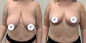This is one of our beautiful breast reduction patient 87