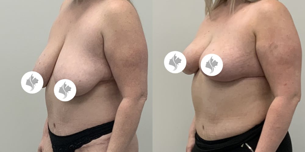 This is one of our beautiful breast reduction patient #87