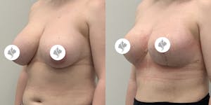 This is one of our beautiful breast reduction patient 18