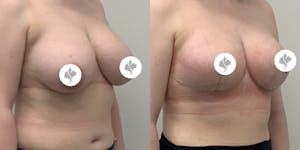 This is one of our beautiful breast reduction patient 18