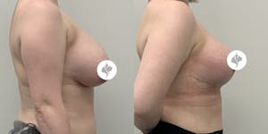 This is one of our beautiful breast reduction patient 18