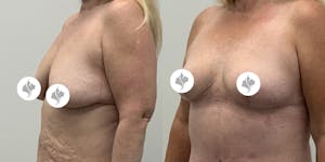 This is one of our beautiful breast reduction patient 19