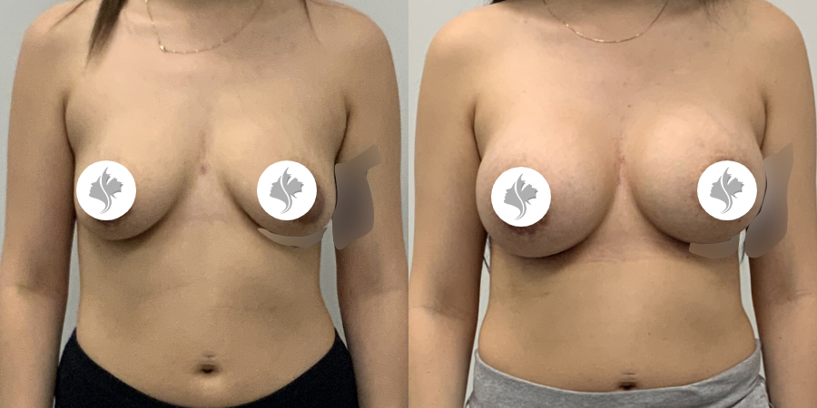 This is one of our beautiful breast augmentation patient 25