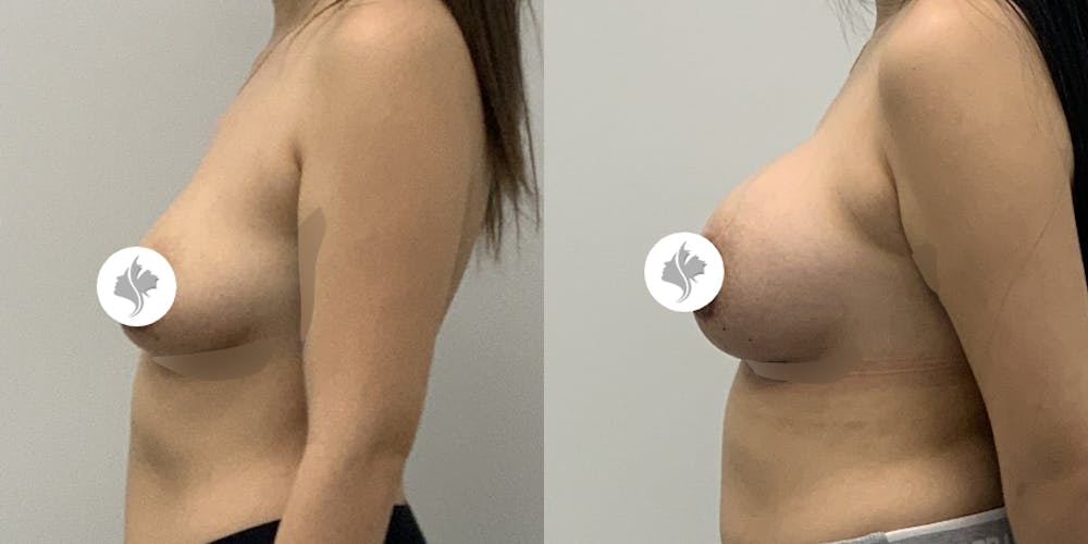 This is one of our beautiful breast augmentation patient #25
