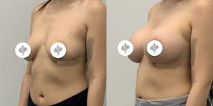 This is one of our beautiful breast augmentation patient 25