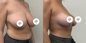 This is one of our beautiful breast reduction patient 20