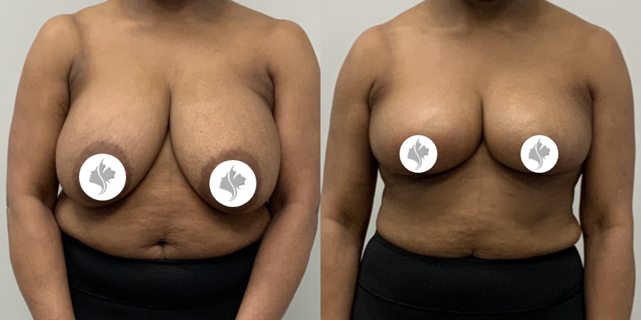 This is one of our beautiful breast asymmetry correction patient 5