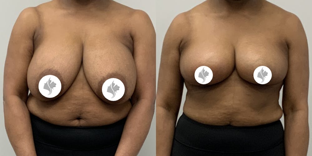 This is one of our beautiful breast asymmetry correction patient #5