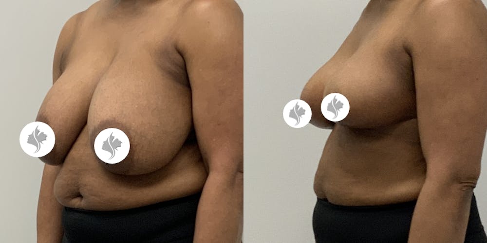 This is one of our beautiful breast asymmetry correction patient #5