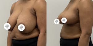 This is one of our beautiful breast asymmetry correction patient 5