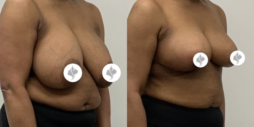This is one of our beautiful breast reduction patient #21
