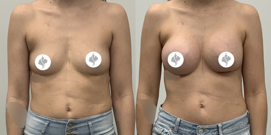 This is one of our beautiful breast augmentation patient 26