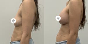 This is one of our beautiful breast augmentation patient 26