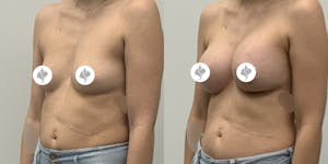 This is one of our beautiful breast augmentation patient 26