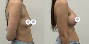 This is one of our beautiful breast augmentation patient 26