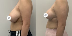 This is one of our beautiful breast reduction patient 22