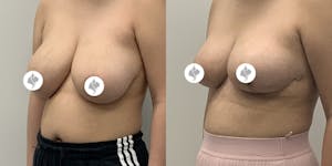 This is one of our beautiful breast reduction patient 22