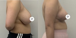 This is one of our beautiful breast reduction patient 22