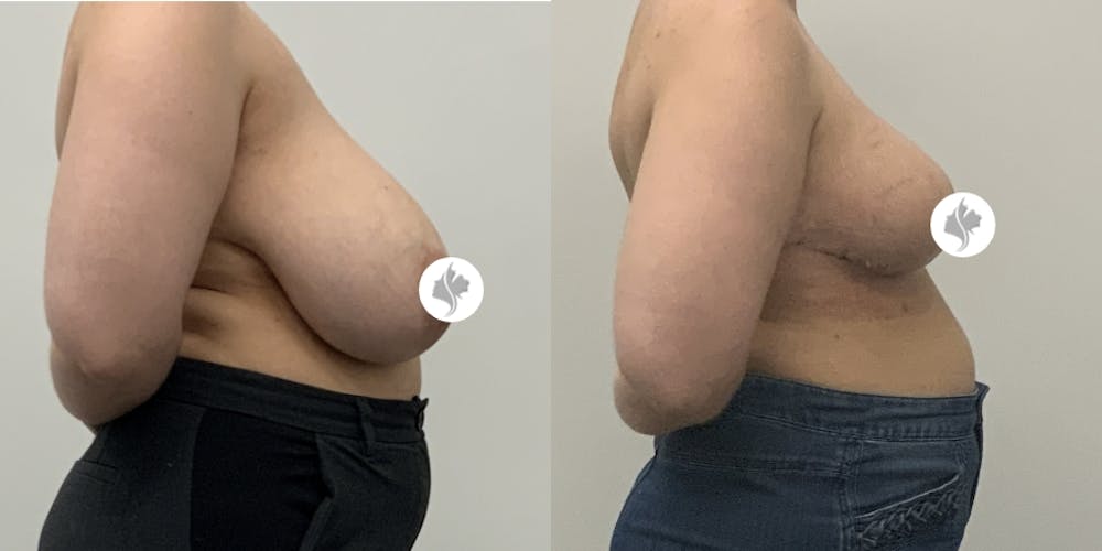 This is one of our beautiful breast asymmetry correction patient #9