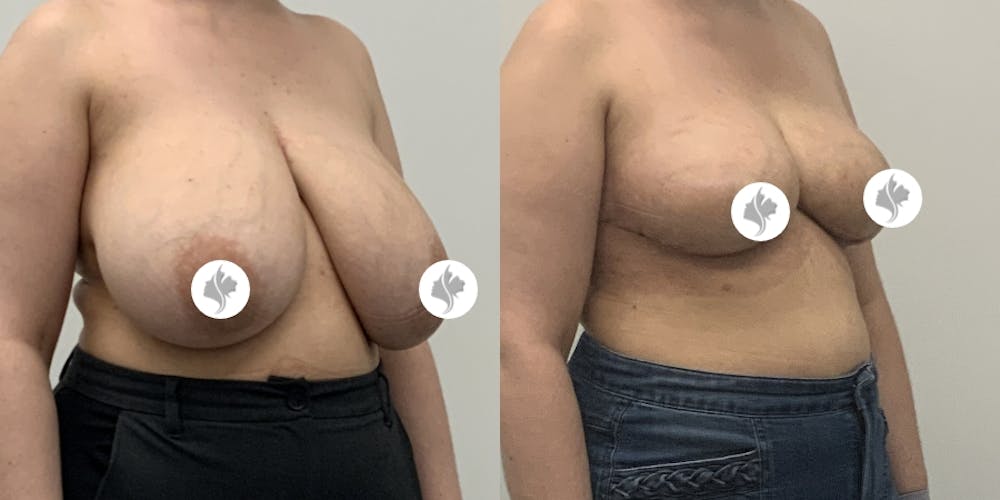 This is one of our beautiful breast asymmetry correction patient #9
