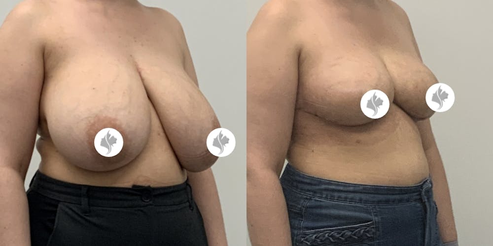 This is one of our beautiful breast reduction patient #23