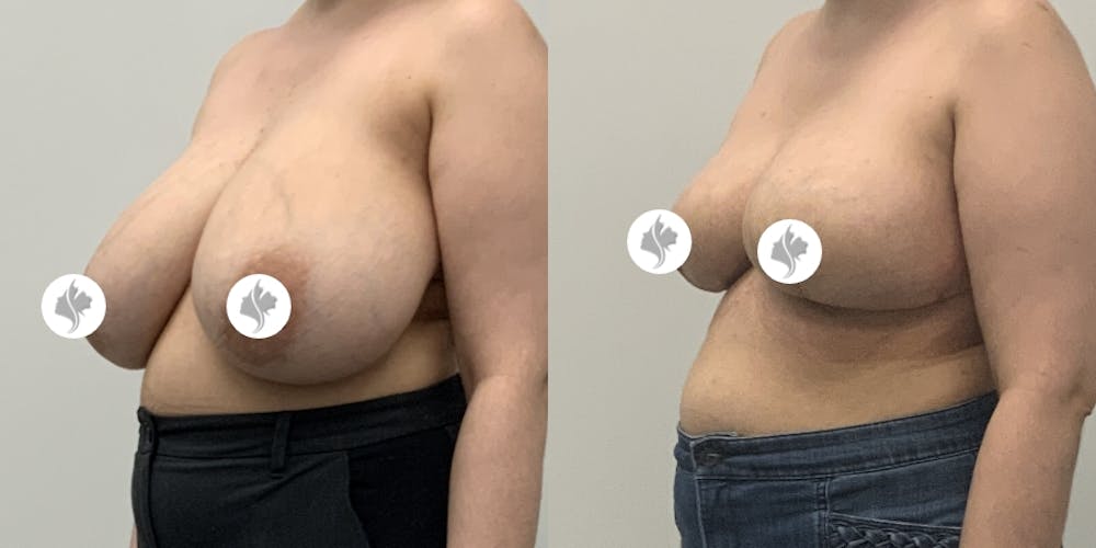 This is one of our beautiful breast asymmetry correction patient #9