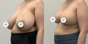 This is one of our beautiful breast reduction patient 23
