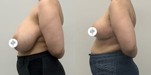 This is one of our beautiful breast reduction patient 23