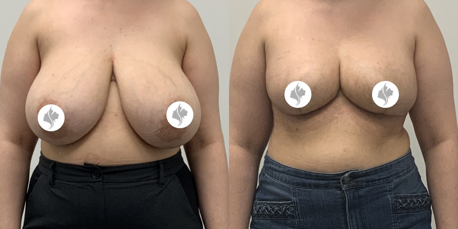 This is one of our beautiful breast asymmetry correction patient 9