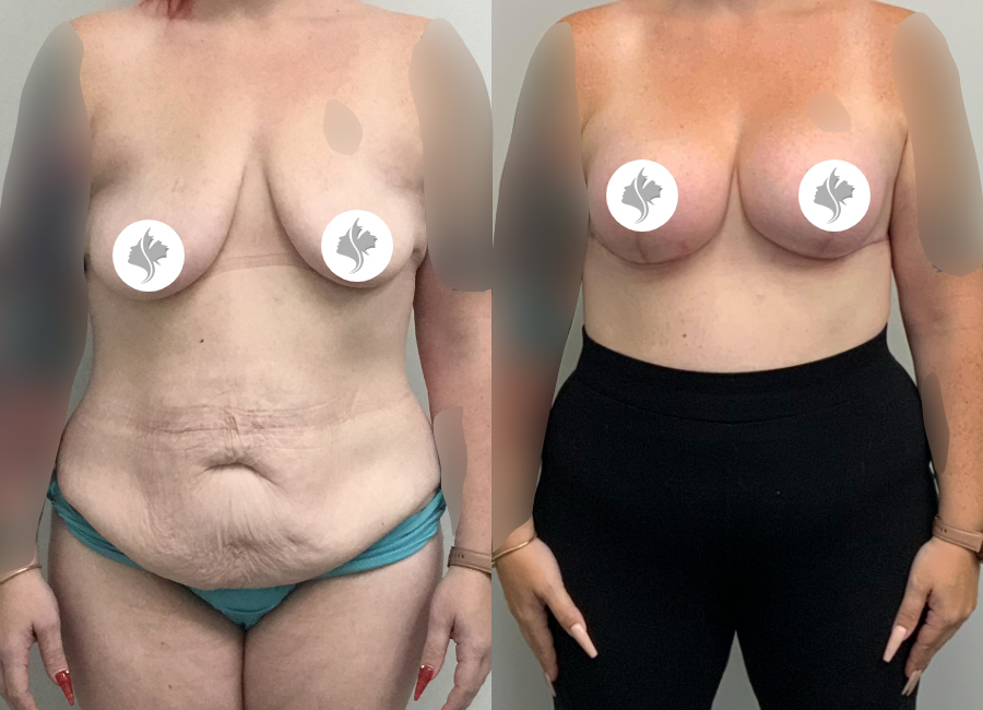 This is one of our beautiful tummy tuck patient 87