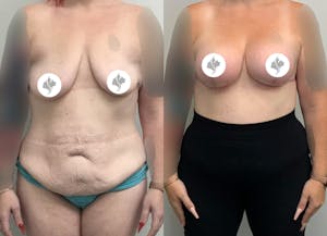 This is one of our beautiful tummy tuck patient 83