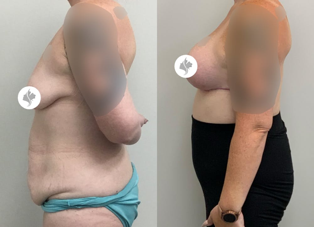 This is one of our beautiful tummy tuck patient #83