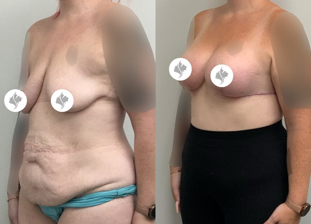 This is one of our beautiful tummy tuck patient #83