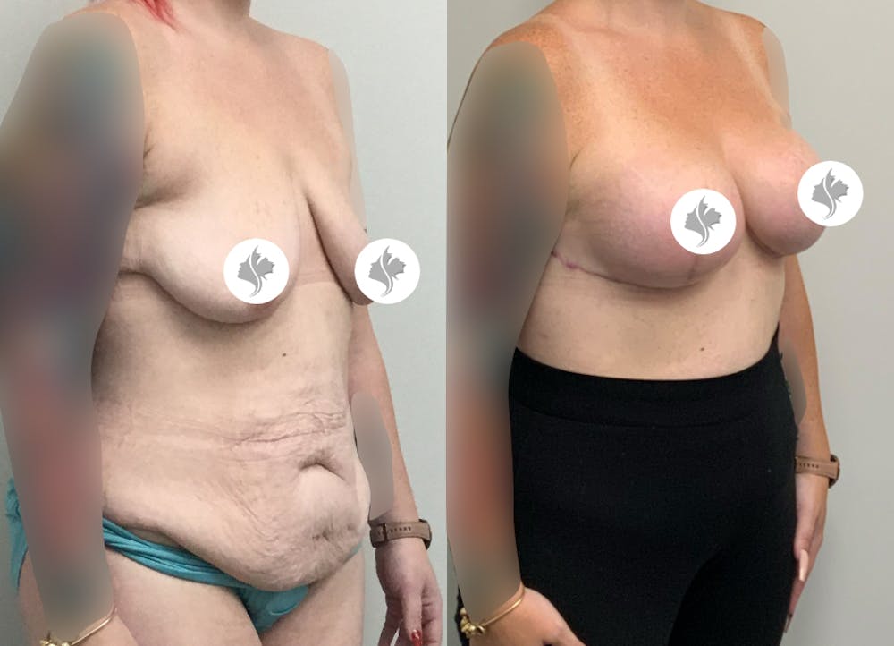 This is one of our beautiful tummy tuck patient #87