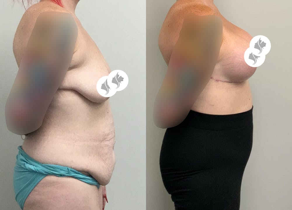 This is one of our beautiful tummy tuck patient #83