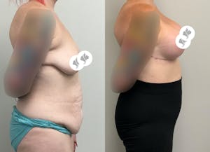 This is one of our beautiful tummy tuck patient 83