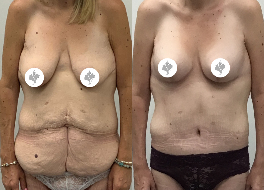 This is one of our beautiful tummy tuck patient 88