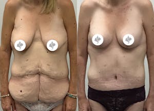 This is one of our beautiful post-bariatric body contouring patient 47