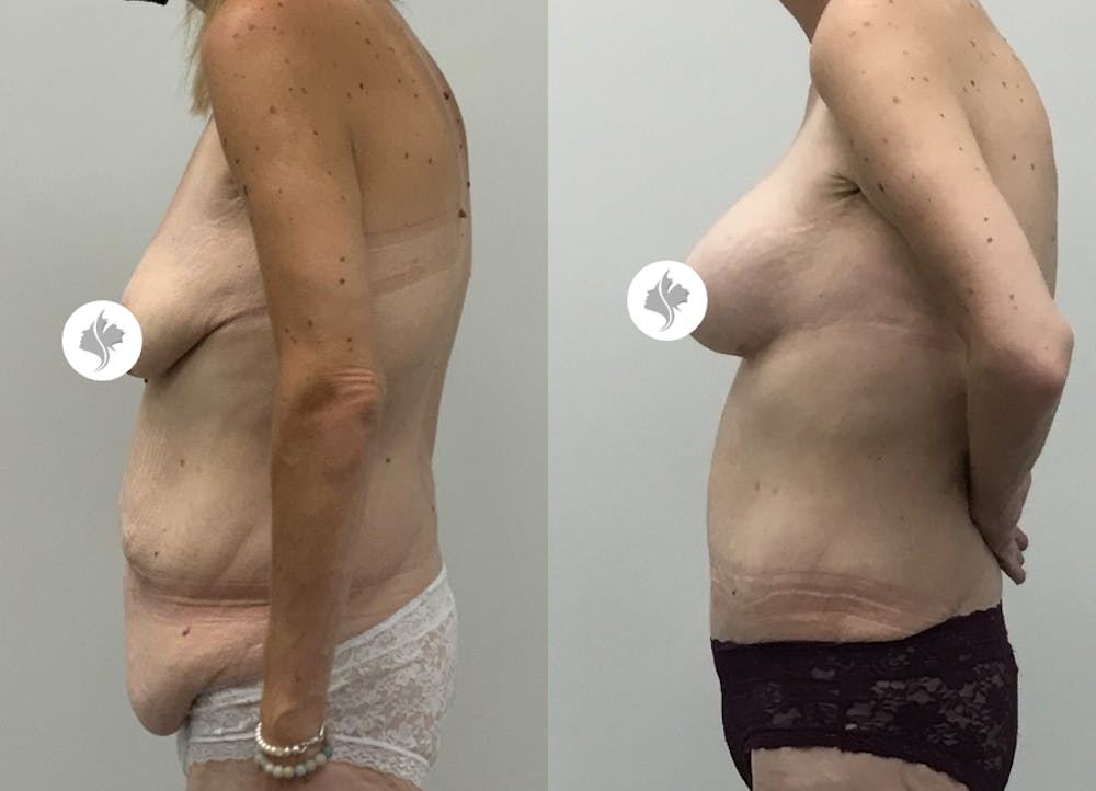 This is one of our beautiful post-bariatric body contouring patient #47