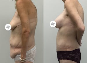 This is one of our beautiful tummy tuck patient 84
