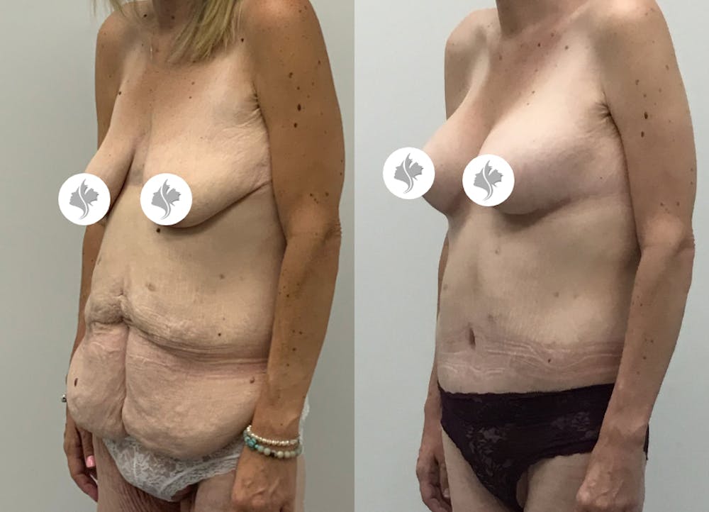 This is one of our beautiful post-bariatric body contouring patient #47