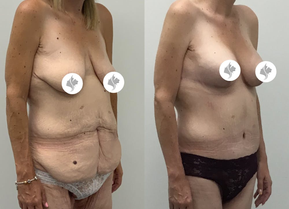 This is one of our beautiful post-bariatric body contouring patient #47