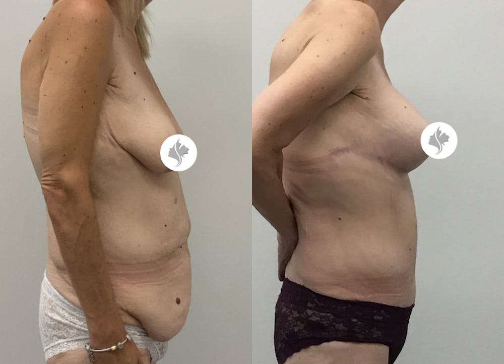 This is one of our beautiful post-bariatric body contouring patient #47