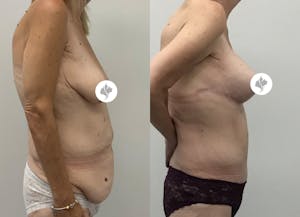 This is one of our beautiful post-bariatric body contouring patient 47