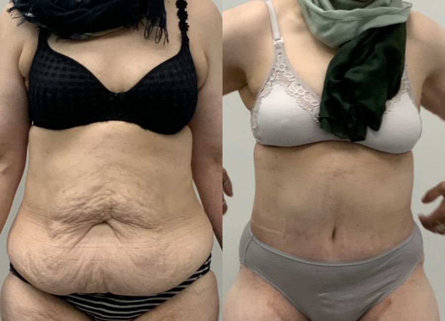 This is one of our beautiful tummy tuck patient 6