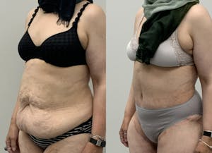 This is one of our beautiful tummy tuck patient 85