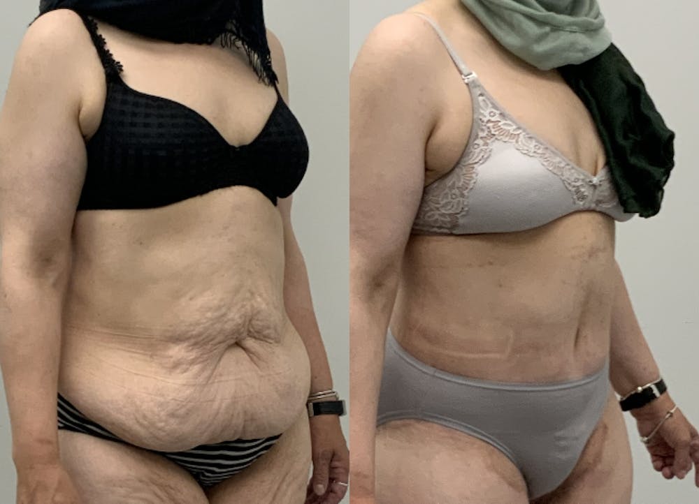 This is one of our beautiful tummy tuck patient #6