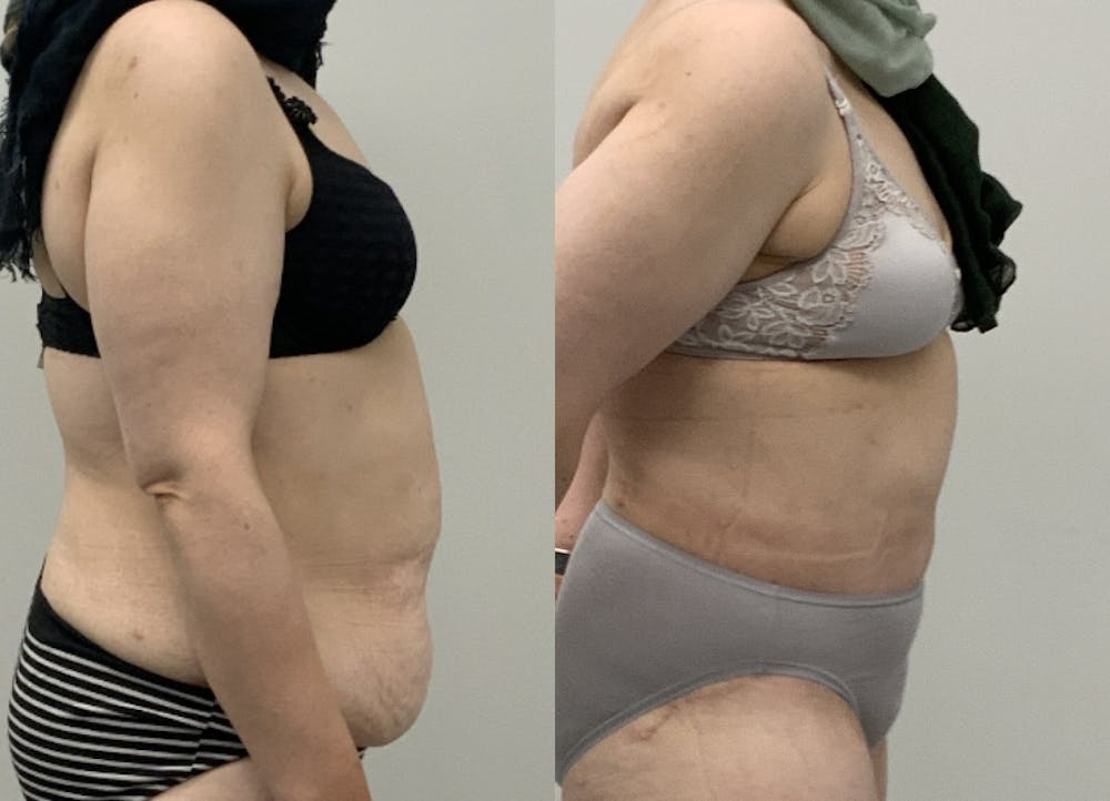 This is one of our beautiful tummy tuck patient #6